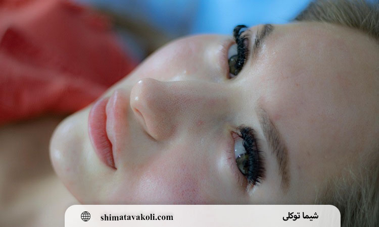 تعداد جلسات کیوسوئیچ برای کک و مک و لک های صورت