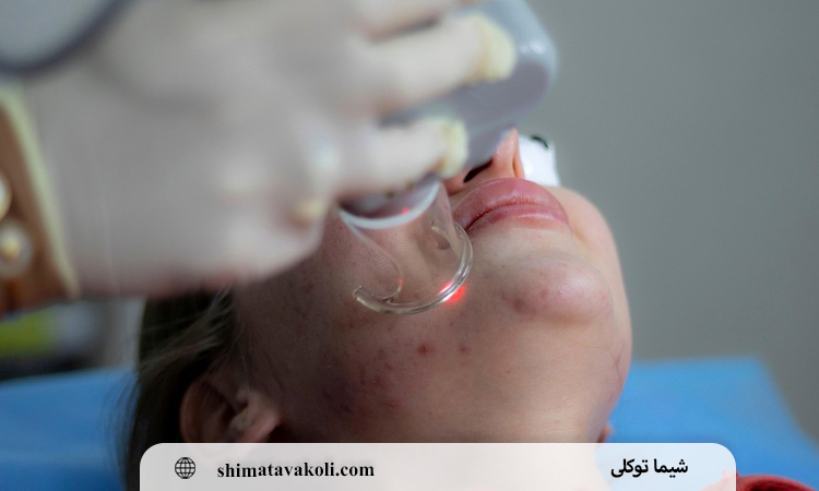 پاک کردن تاتو با لیزر کیوسوئیچ چند جلسه طول می کشد؟