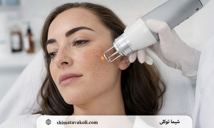 کاربردهای لیزر برای لک صورت و پاک کردن تاتو