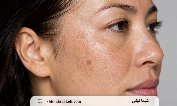 مراقبت های قبل و بعد از لیزر لک صورت