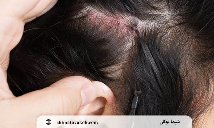 چرا اکستنشن مو باعث سردرد، درد ریشه و کشیدگی پوست سر می شود؟